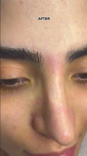 Microdermabrasion Before & After | Instant Glow & Smooth Skin