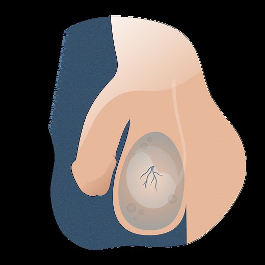 Hidrocele: diagnóstico, tratamiento y recuperación