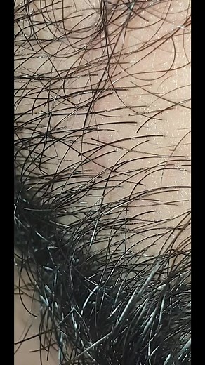 ingrown remove 115 على TikTok