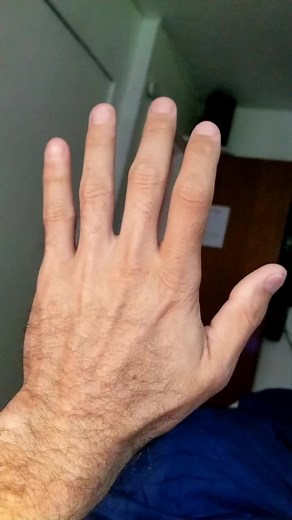 Understanding Parkinson's Disease: Early Signs and Symptoms