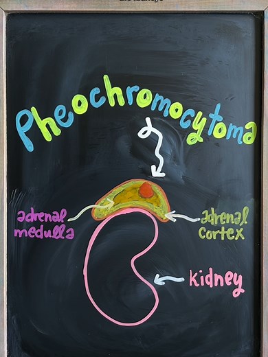 Understanding Pheochromocytoma: Symptoms and Complications