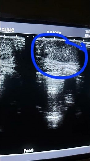 fibroadenoma breast #ultrasound