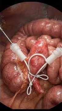 Appendectomy #appendectomy #surgery #operation