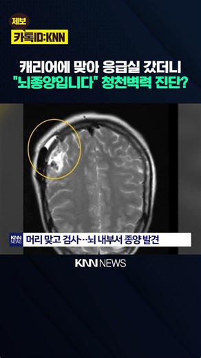 Woman in Her 20s Rushed to Emergency Room After Being Hit by Luggage on Train, Diagnosed 'Termina...