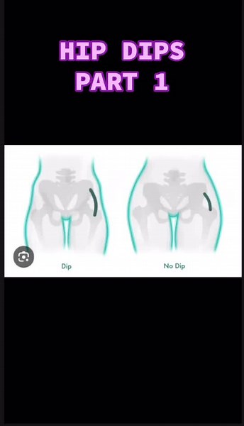 Hip Dips: Understanding Your Body's Natural Curves