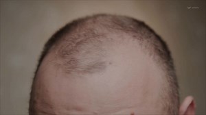 New Study Identifies Root Cause of Hair Loss
