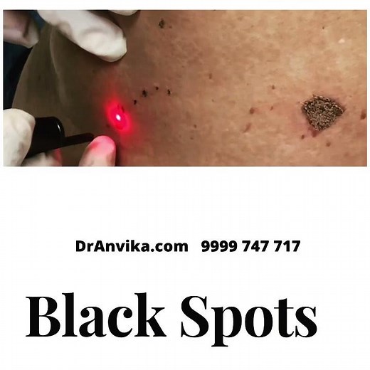 Black Spots Removal By Laser | Dark Spots on Face Treatment | Skin Care Tips | Dr Anvika Mittal