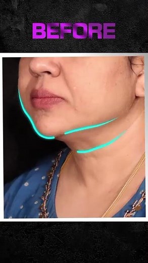 Facelift & Neck Lift Before & After | Timeless Facial Rejuvenation