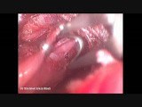 Endoscopic Thyroidectomy: How I do It. • Video • MEDtube.net