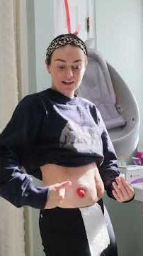 Everyone's stoma looks a little bit different! | Let's Talk IBD