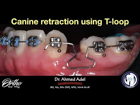 Canine retraction using T-loop mechanics - step by step by dr ahmed adel orthodontics