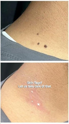 Skin Tag, Mole & Freckle Removal | Safe & Advanced Treatment at Aviv Aesthetics