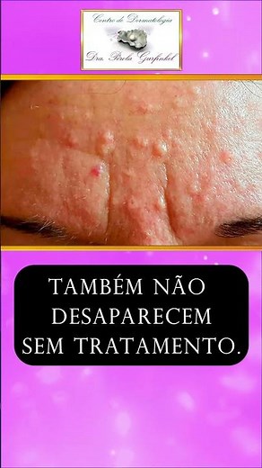 HIPERPLASIA DA GLANDULA SEBACEA #dermatologia #dermatologistasp