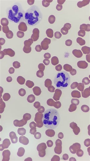 Mustafa Elsobky | Blood smear Cytology of FIP 🐈 / Rouleaux RBC’s indicates Hyperglobulinemia / Neutrophilia / Some Neutrophils with Döhle bodies : small,... | Instagram