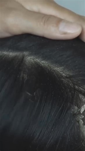 Quick Remove Front Side Scratching Big Dandruff Flakes Satisfying #1 | Mary ASMR