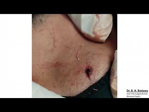 ٍٍScarless forehead cyst