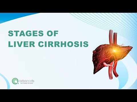 #LiverDisease | What are the 4 Stages of Cirrhosis of the Liver?