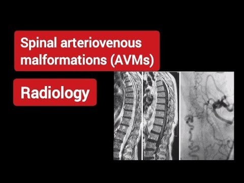 Spinal AVM - MRI & DSA -Radiology Review