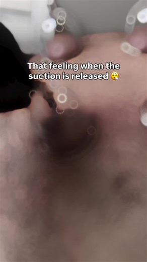 That ahh yeah moment when the suction is released says it all. Dry cupping works by creating controlled suction on the skin, gently lifting the tissue and encouraging increased blood flow to tight or overworked areas. This process helps the body release built-up muscular tension, improve local circulation, and reset areas that feel stiff, heavy, or restricted. Many people don’t realise how much tension they are carrying until the cups come off. That feeling of relief, lightness, and relaxation i