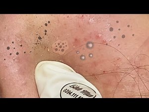 Heavy Blackheads on the Cheeks | Deep Pore Extraction – Spa Linh Mun #72