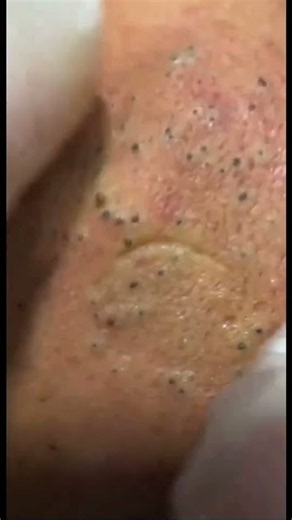 Giant blackhead extraction ✨