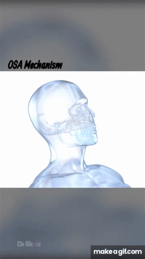 Sleep Apnea Explained on Make a GIF