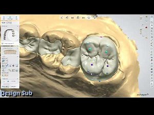 3shape design ( Two inlay on one tooth ) 4 inlay design 👌😀