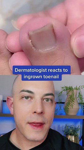 Dermatologist Reacts to Ingrown Toenail Removal