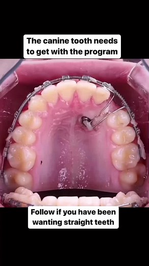 Ectopic canine teeth develop displaced from their normal position. Any permanent tooth can be ectopic, and the cause may be both genetic and environmental. Orthodontic treatment is justified because ectopic canine teeth can migrate in the jaw bone and may damage the adjacent teeth roots and bone.#Ortho #Orthodontist #Braces #Teeth #Dentistry #StraightTeeth