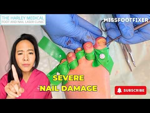 Long-Term Fungal Toenails Removal 👣 All 10 Nails Affected (Part 2) by Miss Foot Fixer Marion Yau