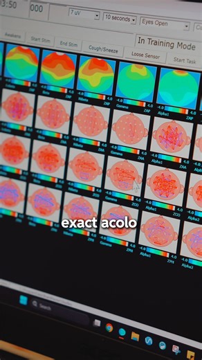 BrainMap (qEEG) este o analiză neurofuncțională avansată, bazată pe tehnologia medicală EEG, care măsoară activitatea electrică a diferitelor zone ale creierului și identifică tipare de hiperactivare, hipoactivare sau dezechilibru. Practic, este o „hartă” a funcționării creierului, care arată ce regiuni lucrează prea mult, prea puțin sau în mod nearmonios, informații care sunt esențiale pentru personalizarea tratamentelor în anxietate, depresie, ADHD, insomnie, migrene și multe altele. 💬Dacă vr