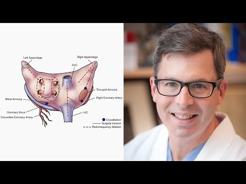 Surgeon Q&A: Cox-Maze IV Insights & AFib Pathology to Help Your Practice (with Dr. Marc Gillinov)