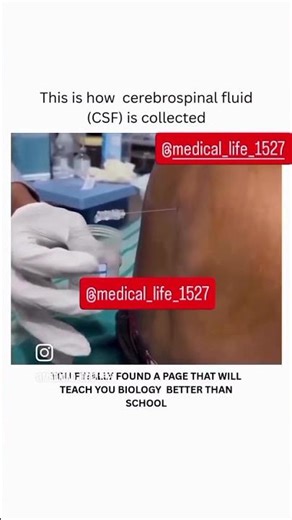 CSF Fluid Collection 💉💉🥼🚑🏨🏥💉💉#medical #medicalstudent #viralvideo #love #trending #trauma #reels