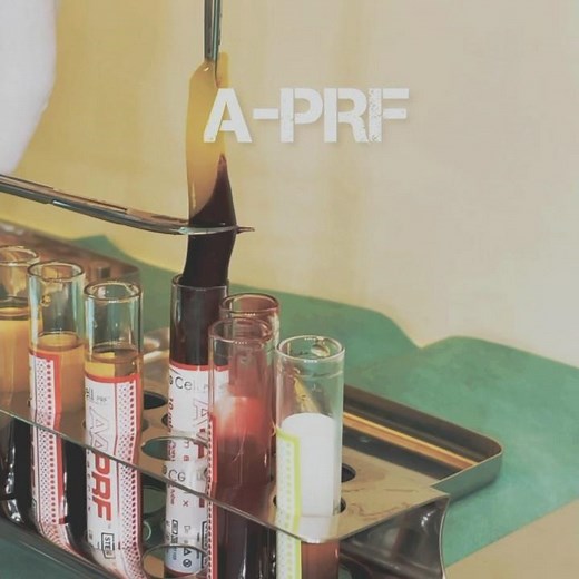 Platelet Rich Fibrin (PRF) Preparation for Membrane and Sticky Bone for Grafting #prf #oralsurgery