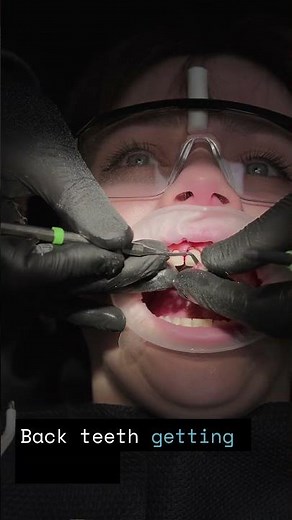 Zirconia vs. Porcelain Crowns Find Your Perfect Match