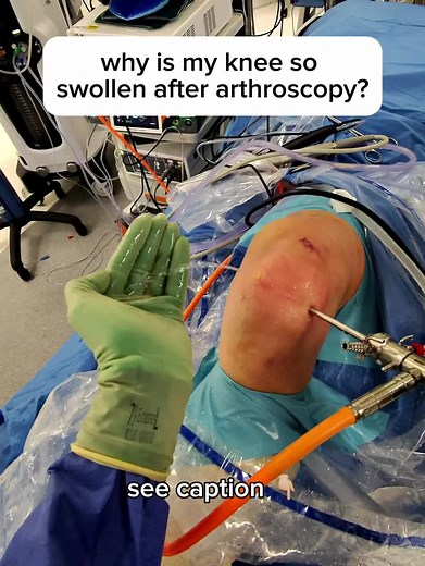 Why is your knee so swollen after surgery? One reason most people don’t expect — the fluid we use during the operation. During keyhole knee surgery, sterile fluid is pumped into the joint under pressure. It expands the space, improves visibility, and washes away blood and debris. Some stays in the joint. Some leaks into the soft tissues. Some pours straight out — like you see here. That’s why the knee looks swollen immediately after surgery. (Also why I wear boots to operate. Wet socks aren’t in