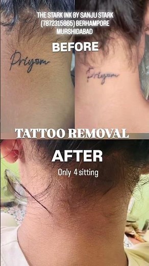 RESULT IN ONLY 4 SITTINGS | TATTOO REMOVAL | BERHAMPORE | STARK INK | SANJU STARK | PICO LASER