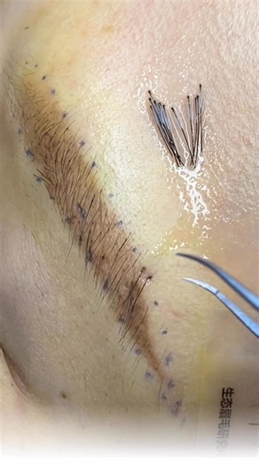 Eyebrow transplantation.Eyelash transplant. Trasplante de cejas.Trasplante de pestañas. Transplante de cílios. Трансплантация бровей.Трансплантация ресниц. #russia #brasil #paris #korea #portugal #uk #eyelash #model #paris #pakistan #pestana #pestaña #travelling #curso #eyebrow #beauty #brasil #usa #training #russia #technology #brasil #brazil #doctor #chinatravel | Yi Chen
