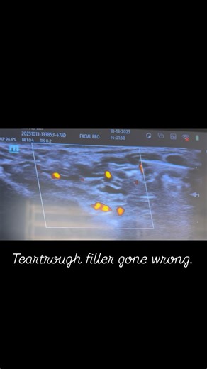 “Fillers in the tear troughs may look beautiful at first, but over time they can migrate or attract water — causing puffiness or swelling that looks very unnatural. With ultrasound guidance, I can easily locate and dissolve unwanted filler precisely, without guessing. It’s safer, faster, and gives my patients their natural look back.” #dmvmedspa #nurseinjectors #ultrasound #ultrasoundguidedinjection #filleredema | Sadiya Naseem