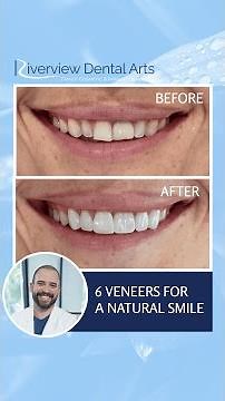 Before ➡️ After: 6 veneers transformed this smile