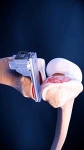 154K views · 546 reactions | Unicondylar Knee Arthroplasty #medical3d #medical3danimation #surgery #kneesurgery | Mix Dancing Events | Facebook