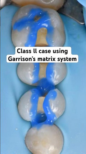 Class 2 case using Garrison’s Matrix System