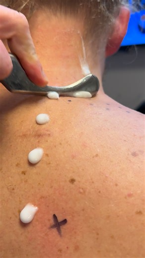 Dr. Kyle Ross on Instagram: "🏆 Instrument Assisted Soft Tissue Mobilization (IASTM) helps break up scar tissue and fascial restrictions using specially designed tools. This technique promotes better circulation, restores mobility, and speeds up recovery from overuse or injury. #IASTM #SoftTissueTherapy #ChicagoChiropractic #chiropractor #drkyleross"
