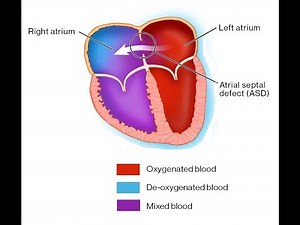 Atrial Septal Defect: Patient information. Device vs Surgical closure