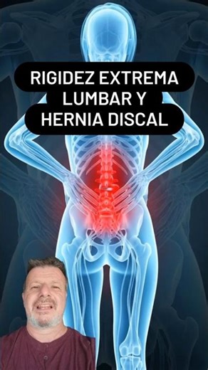 CUANDO TU ESPALDA BAJA TE GRITA: RIGIDEZ LUMBAR Y HERNIA DISCAL