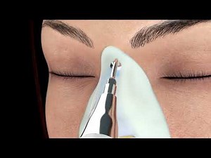 Rinoplastia ultrasónica: la técnica más precisa y menos invasiva | Cirugía de nariz