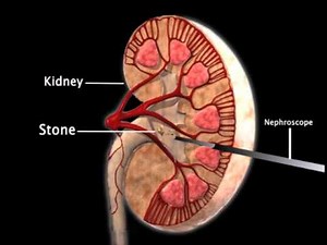 PCNL Animation Video