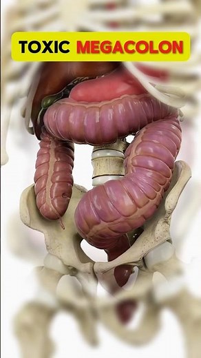 The Most Dangerous Gut Emergency You’ve Never Heard Of