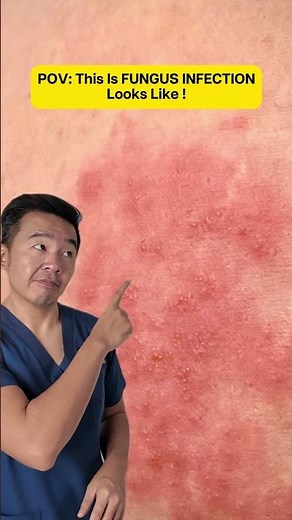 FUNGUS INFECTION