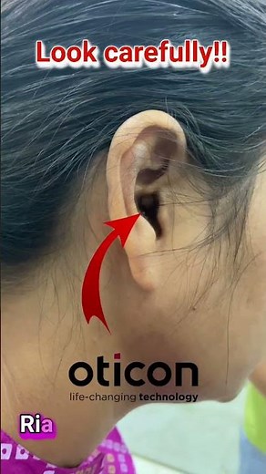 Oticon Ria 2 Custom made Completely in canal (CIC) Hearing aids #hearing #hearingloss #hearingaids